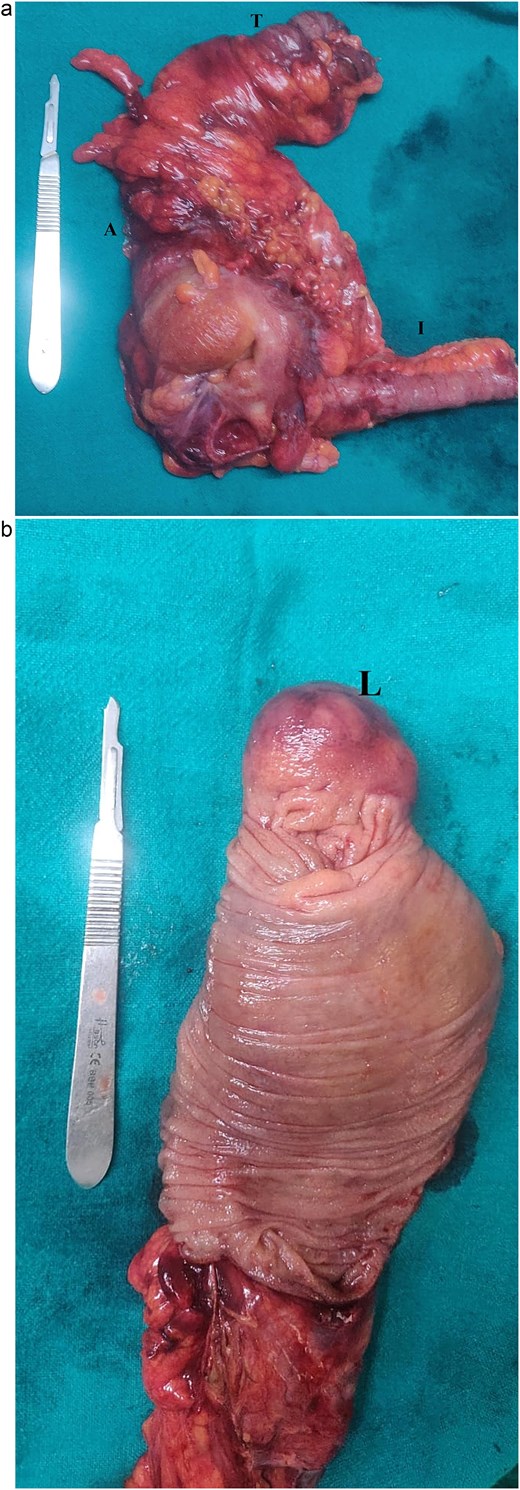 (a) Right hemicolectomy specimen showing the proximal transverse colon (T) ascending colon (A) and terminal ileum (I). (b) Cut section shows well circumscribed, sessile, nodular mass serving as the lead point (L).