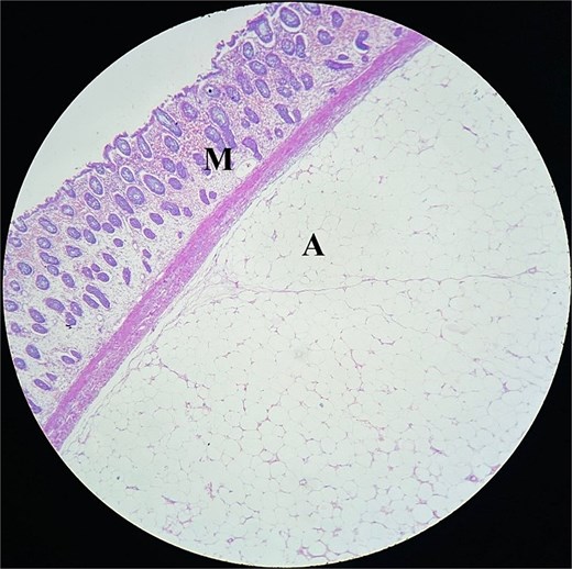 Histopathology section showing compressed and thinned colonic mucosa(M) with lobules of mature adipose tissue(A) in the submucosa separated by thick and thin fibrocollagenous septa.
