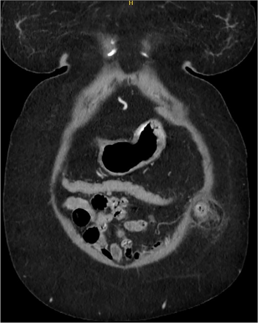 Axial section of the CT showing the ventral hernia diameter.