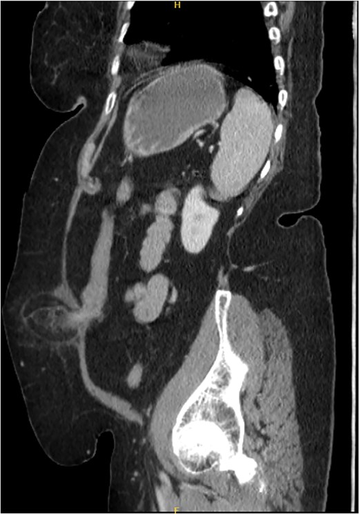 Coronal section of CT abdomen and pelvis showing the ventral hernia.