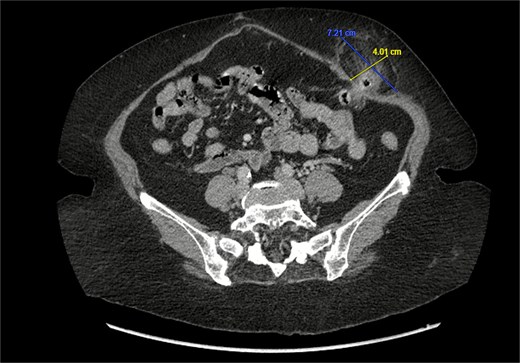 Sagittal section of CT abdomen and pelvis showing the ventral hernia.