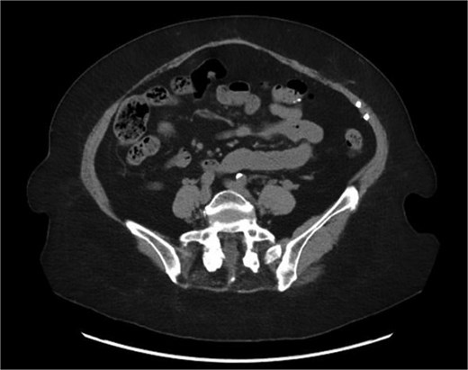 Axial section of the CT 6 months after the surgery.