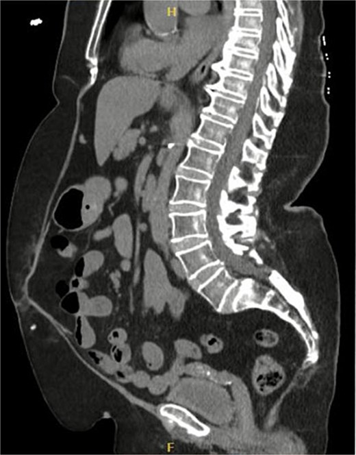 Sagittal section of CT abdomen and pelvis 6 months after the surgery.
