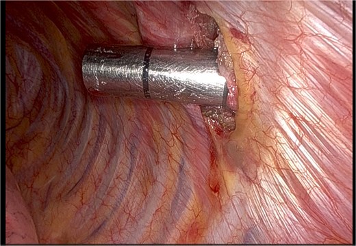 Intraoperative port placement in the 7th intercostal space.