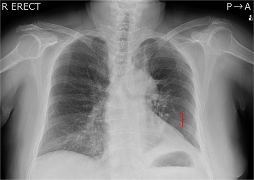 Chest X-ray taken on postoperative Day 3. A left 8th rib fracture was observed (bracket).