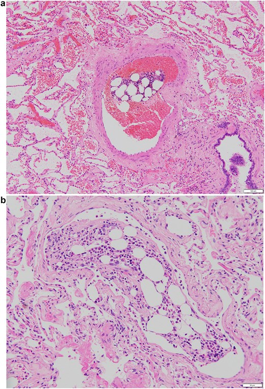 Representative images of embolism in the pulmonary artery. (a) An embolism in the relatively large pulmonary artery. The size of the embolism was 540 × 200 mm. (b) An embolism in the pulmonary artery in high-magnification view. The pulmonary embolism measured 290 × 160 mm in diameter.