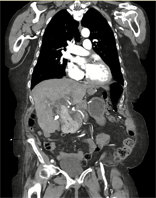CT demonstrating gallstone within the common bile duct 1 month prior to this admission.