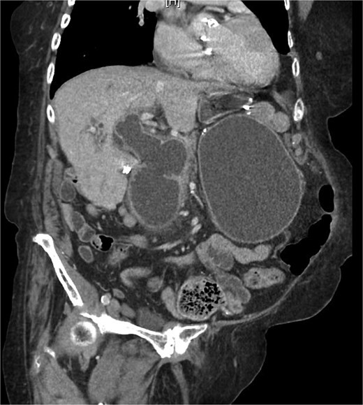 Choledochoduodenostomy.