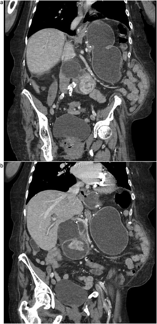 (a and b) CT demonstrating gallstone in D3-D4 with BPD limb obstruction.