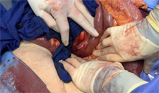 Location of gallstone within D3-D4.