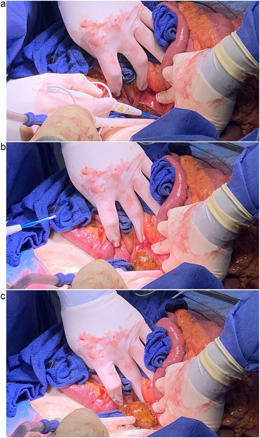 (a, b, and c) Extraction of gallstone via longitudinal duodenotomy.