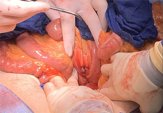 Two-layer, transverse closure of duodenotomy.