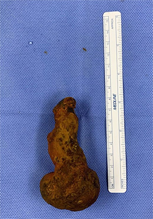 Extracted gallstone.