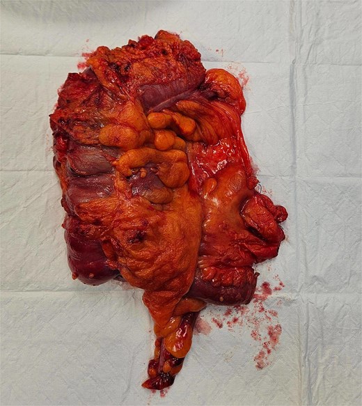 Right hemicolectomy.