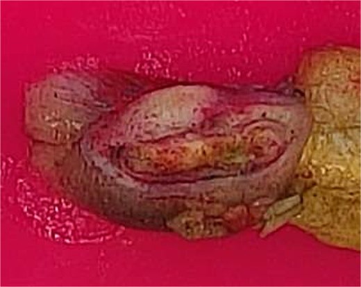 Resected small bowel segment with attached mesentery.