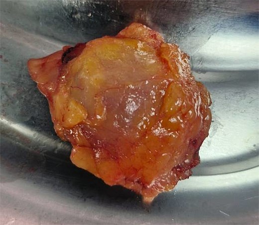 Left axillary lymph node.