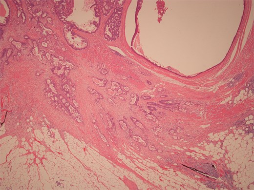 Low power view of colonic adenocarcinoma invading muscularis propria and pericolonic fat.