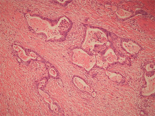 High power view of colonic adenocarcinoma showing complex glandular structures lined by epithelial cells with high grade atypia, and lumina containing necrotic debris, invading beyond the mucosa.