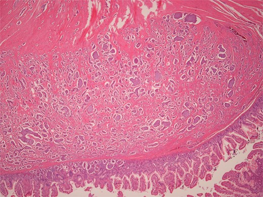 Low power view of submucosal neuroendocrine tumour.