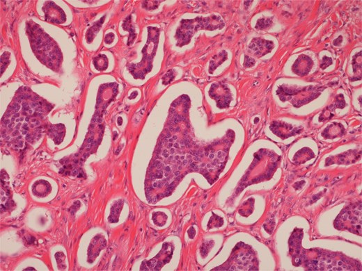 High power view of well-differentiated neuroendocrine tumour showing nests of monotonous cells with round nuclei and “salt and pepper” chromatin.