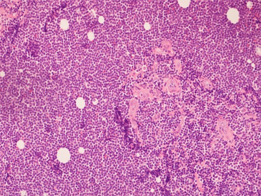 High power view showing a proliferation of monotonous small lymphoid cells.
