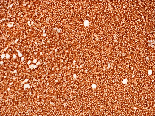 Diffusely and strongly positive CD20 staining of neoplastic lymphoid cells.