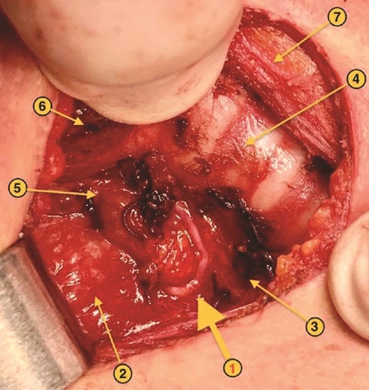 NRR-ILN: anatomical landmarks. 1. Right ILN. 2. Right cervical neurovascular bundle. 3. Esophagus. 4. Trachea. 5. Right superior parathyroid gland. 6. Right cricothyroid muscle. 7. Left sternothyroid muscle.