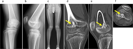 Preoperative radiographic and CT findings. (a) Anteroposterior radiograph of the right knee. (b) Lateral radiograph of the right knee. (c) Full-length standing anteroposterior radiograph of the lower extremities showing valgus deformity (femorotibial angle: right, 165°; left, 172°). (d) Coronal CT image. (e) Sagittal CT image. (f) Axial CT image showing early epiphyseal closure of the distal femur caused by a physeal bar (arrow), located adjacent to the posterior cortical bone.