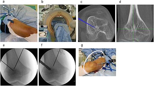 Intraoperative setup and portal creation. (a) Two 3-mm pins were inserted into the femoral diaphysis to secure the tracker of the Stealth Station™ system. (b) Intraoperative CT was performed using the O-arm™ system and integrated with the navigation system. (c) The location and trajectory to the physeal bar were identified using navigation. (d) Two 1.6-mm Kirschner wires were inserted from the medial and lateral aspects toward the physeal bar under fluoroscopic guidance. (e) Drill portals (8 mm) were created along the wire tracts. (f) A 4-mm arthroscope was inserted through one portal for endoscopic visualization.