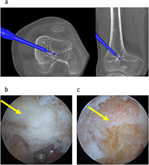 Endoscopic and navigational views during resection. (a) Physeal bar resection was performed using a high-speed drill under navigation guidance. (b) The physeal bar (arrow) was directly visualized endoscopically. (c) Following excision, residual growth cartilage (arrow) was observed at the site.