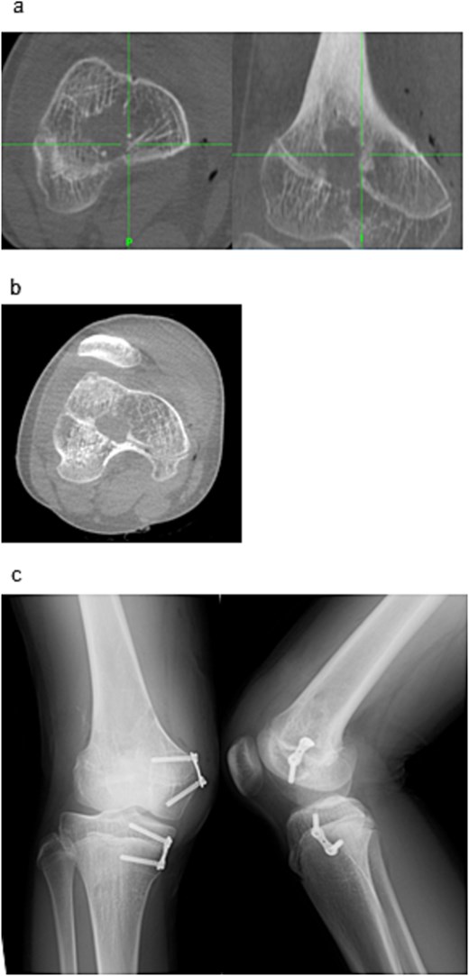 Post-resection imaging and implant placement. (a) Post-resection CT confirming complete removal of the physeal bar. (b) No evidence of cortical perforation was seen. (c) Postoperative radiographs (anteroposterior and lateral) showing placement of the eight-plate across the distal medial femur and proximal medial tibia.