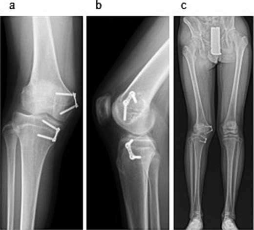 Radiographic findings at 24-month follow-up. (a) Anteroposterior radiograph of the right knee. (b) Lateral radiograph of the right knee. (c) Full-length standing anteroposterior radiograph of the lower extremities.