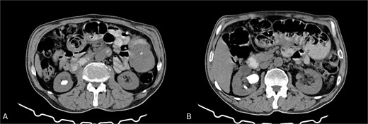 Contrast-enhanced CT of the abdomen. (A) Axial view showing a soft tissue mass-like lesion in the left abdomen (star). (B) Dilated bowel loops with mild to moderate thickening of the bowel wall.
