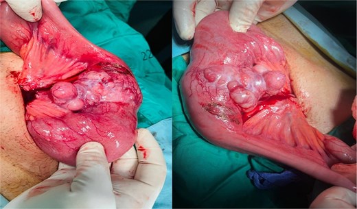 Intraoperative image showing the affected small bowel and mesentery with distended bowel proximal to the mass.