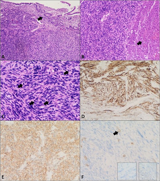Leiomyosarcoma of the small bowel. (A) Section shows a malignant spindle cell neoplasm composed of intersecting fascicles with overlying small bowel mucosa (arrow) (H&E, ×4). (B) Areas of tumour necrosis are seen (arrow) (H&E, ×10). (C) Increased mitotic activity is noted (arrows) (H&E, ×20). (D) Immunohistochemistry showing positive Desmin. (E) Smooth muscle actin (SMA) immunostain positivity. (F) Negative CD117 (c-kit), Dog-1 (right insert), and S100 (left insert) immunostains confirming the diagnosis of leiomyosarcoma. Arrow in panel F highlights mast cells as a positive internal control for CD117 immunostain.
