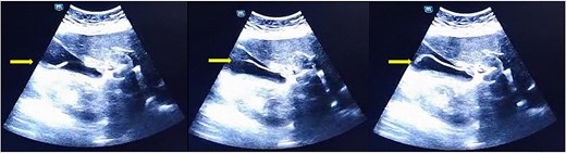 Floating and zigzagging central anechoic tube which lack of shadowing into the gallbladder.