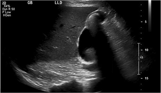 Ultrasound of gallbladder with the pyloric gland adenoma in view.
