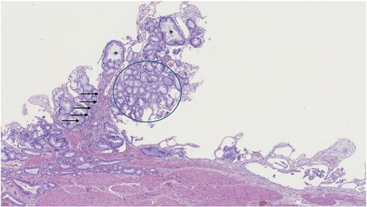 Low magnification of polypoid lesion demonstrating a fibrovascular core (arrows), and tightly packed pyloric type glands (circle) with occasional cystic dilatation (asterisk). Haematoxylin and eosin 4×.