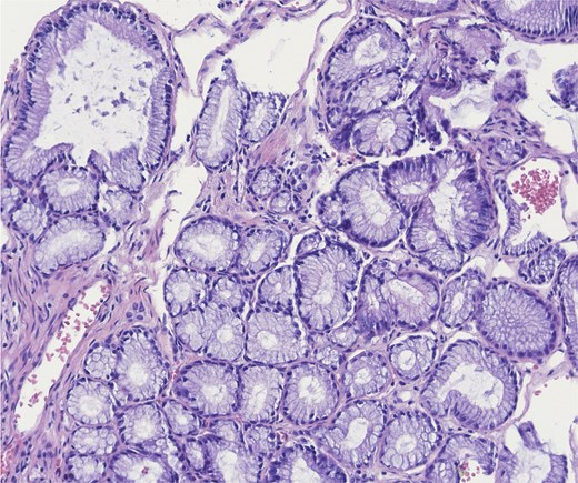 Higher power of bland pyloric glands lined by cuboidal or columnar mucus secreting cells with apical mucinous cytoplasm. Haematoxylin and eosin 20×.
