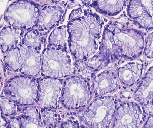 Higher power of bland pyloric glands lined by cuboidal or columnar mucus secreting cells with apical mucinous cytoplasm. No nuclear overlap and no mitosis. Haematoxylin and eosin 40×.