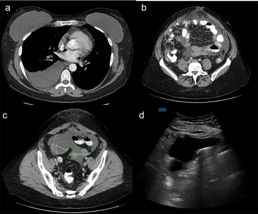 (a) Demonstrating right pleural effusion, likely from pulmonary coccidioidomycosis. (b) Demonstrating thickened anterior omental fat concerning for peritoneal carcinomatosis. (c) Demonstrating a right adnexal mass. (d) Ultrasound demonstrating a large amount of ascites.