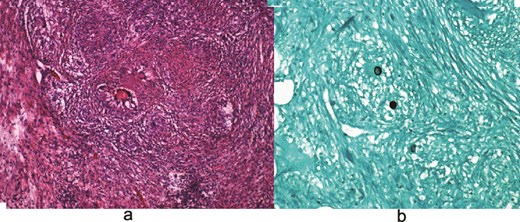(a) Hematoxylin and eosin (H&E) images demonstrating granulomas. (b) Grocott-Gomori methenamine silver (GMS) stain highlighting fungal organisms.