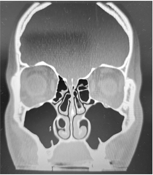 Paranasal sinus CT scan in the coronal plane showing bilateral concha bullosa in the superior turbinates and pneumatization of the right inferior turbinate (inferior concha bullosa).