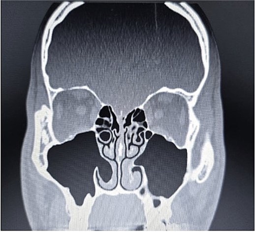 Paranasal sinus CT scan in the coronal plane demonstrating bilateral inferior concha bullosa with communication to the maxillary sinuses.