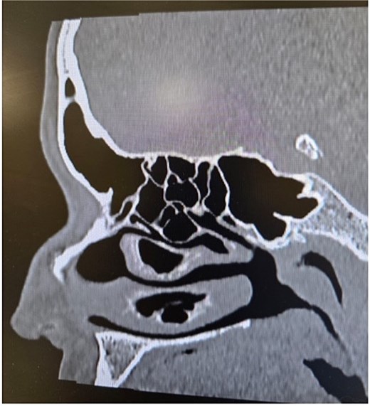 Paranasal sinus CT scan in the sagittal plane demonstrating middle concha bullosa and inferior concha bullosa.