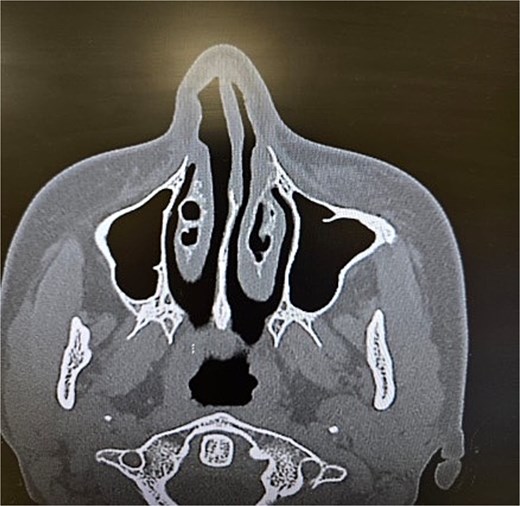 Paranasal sinus CT scan in the axial plane demonstrating inferior concha bullosa.