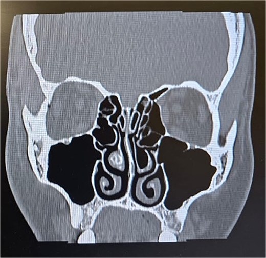 Paranasal sinus CT scan in the coronal plane demonstrating left middle concha bullosa and inferior concha bullosa.