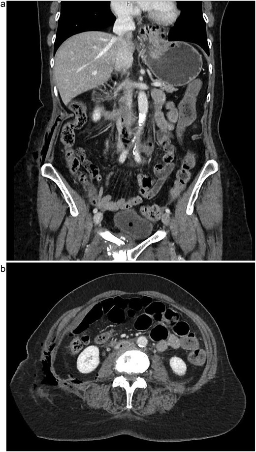 (a) Coronal view of thrombus and air in IVC, initial imaging. (b) Axial view of thrombus and air in IVC, initial imaging.