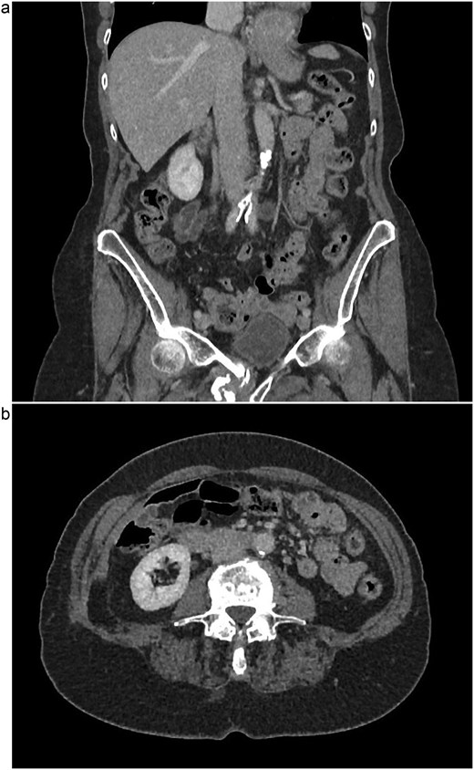 (a) Coronal view of resolved thrombus, 5 months post-op. (b) Axial view of resolved thrombus, 5 months post-op.