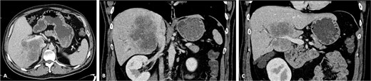 CT scan of the intrahepatic cholangiocarcinoma before chemotherapy. (A) Axial CT scan of the intrahepatic cholangiocarcinoma centred in liver segments 5, 7, and 8, with extension to segment 1 and invasion of the PV and IVC; (B) coronal CT scan view of the vascular relation between the cholangiocarcinoma and the IVC; and (C) vascular invasion of the PV.